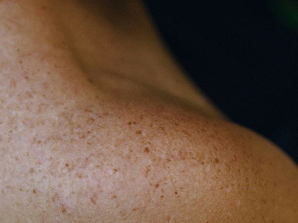 Melanoma
